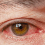 An eye condition called uveitis.