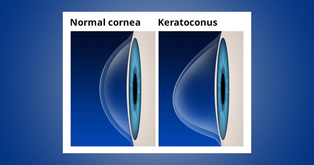 Keratoconus Causes & Symptoms - OasisEye Specialists