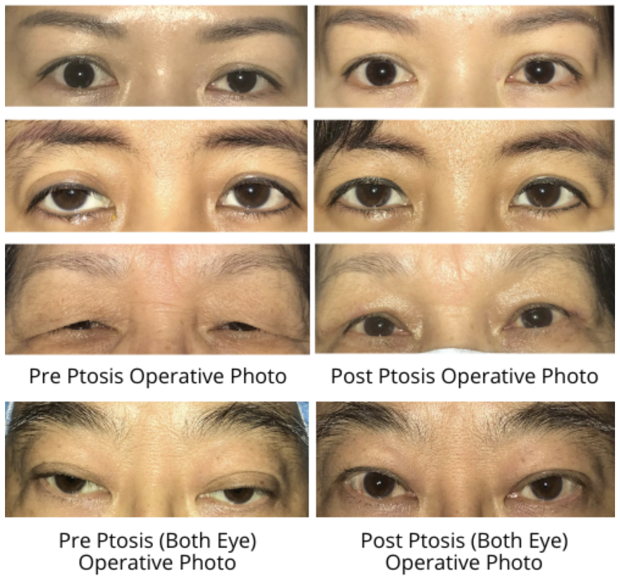 Severe Congenital Ptosis