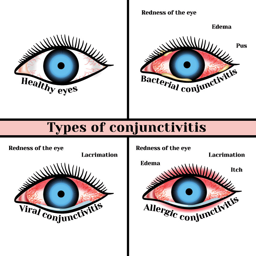Types Of Red Eye And Their Causes OasisEye Specialists