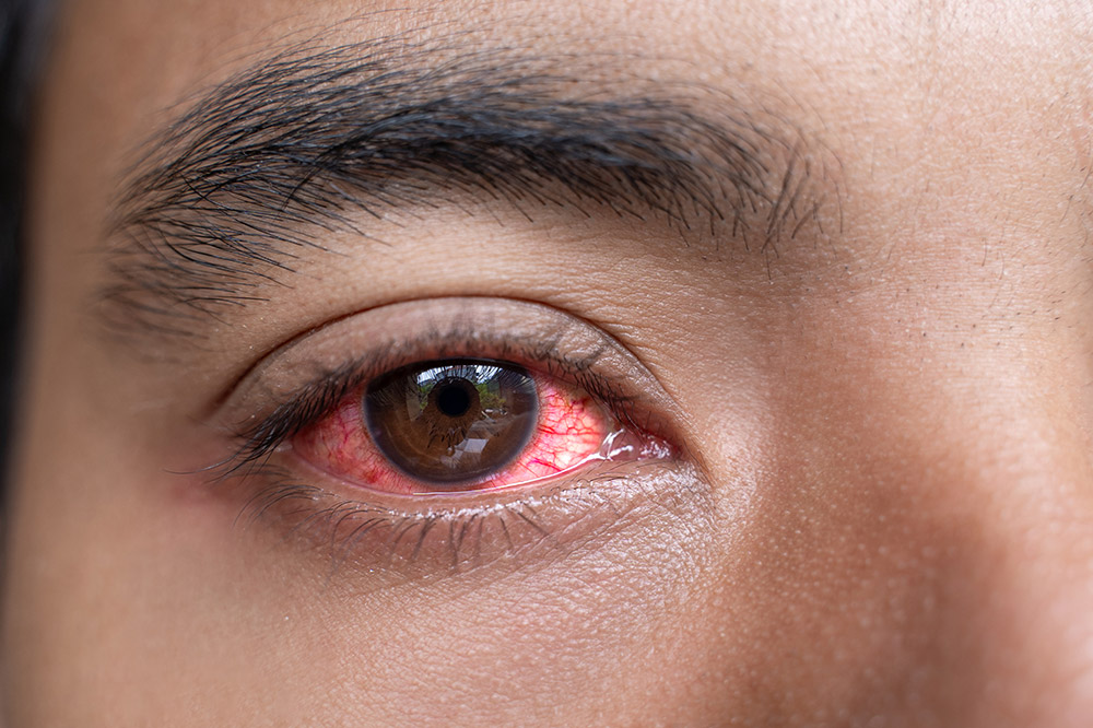 Red Eyes Problem Red Eye Treatment in Kuala Lumpur (Malaysia)