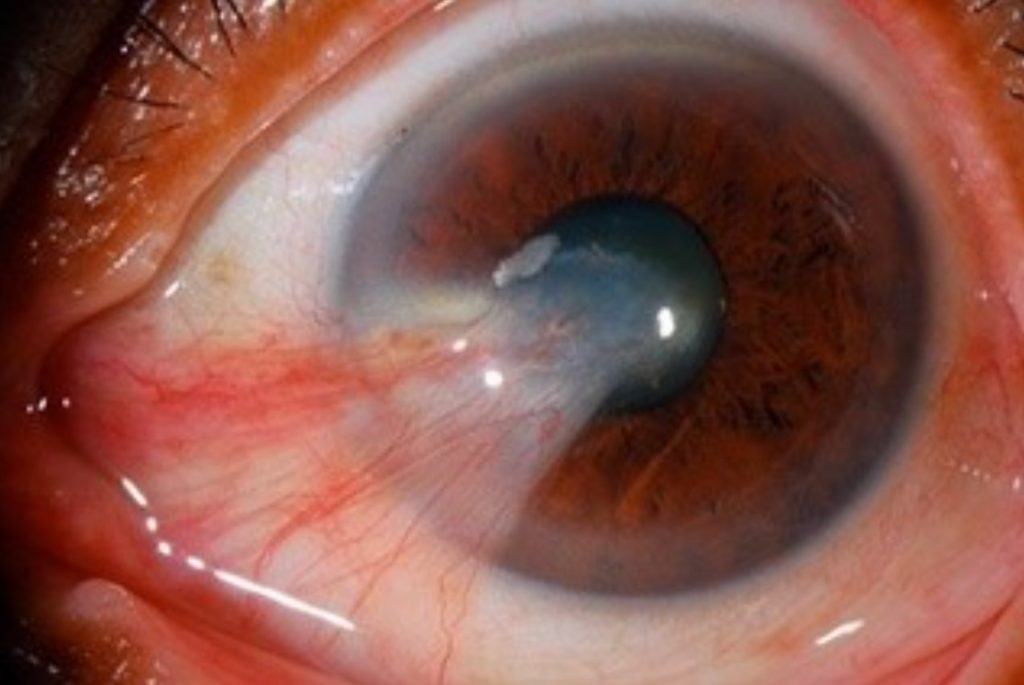 UV Light & its effects to the eye OasisEye Specialists