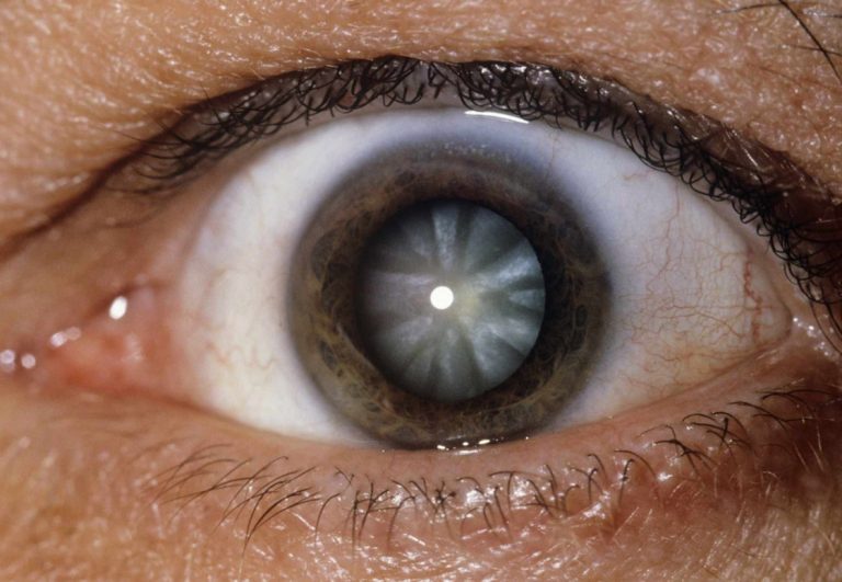 UV Light & its effects to the eye OasisEye Specialists