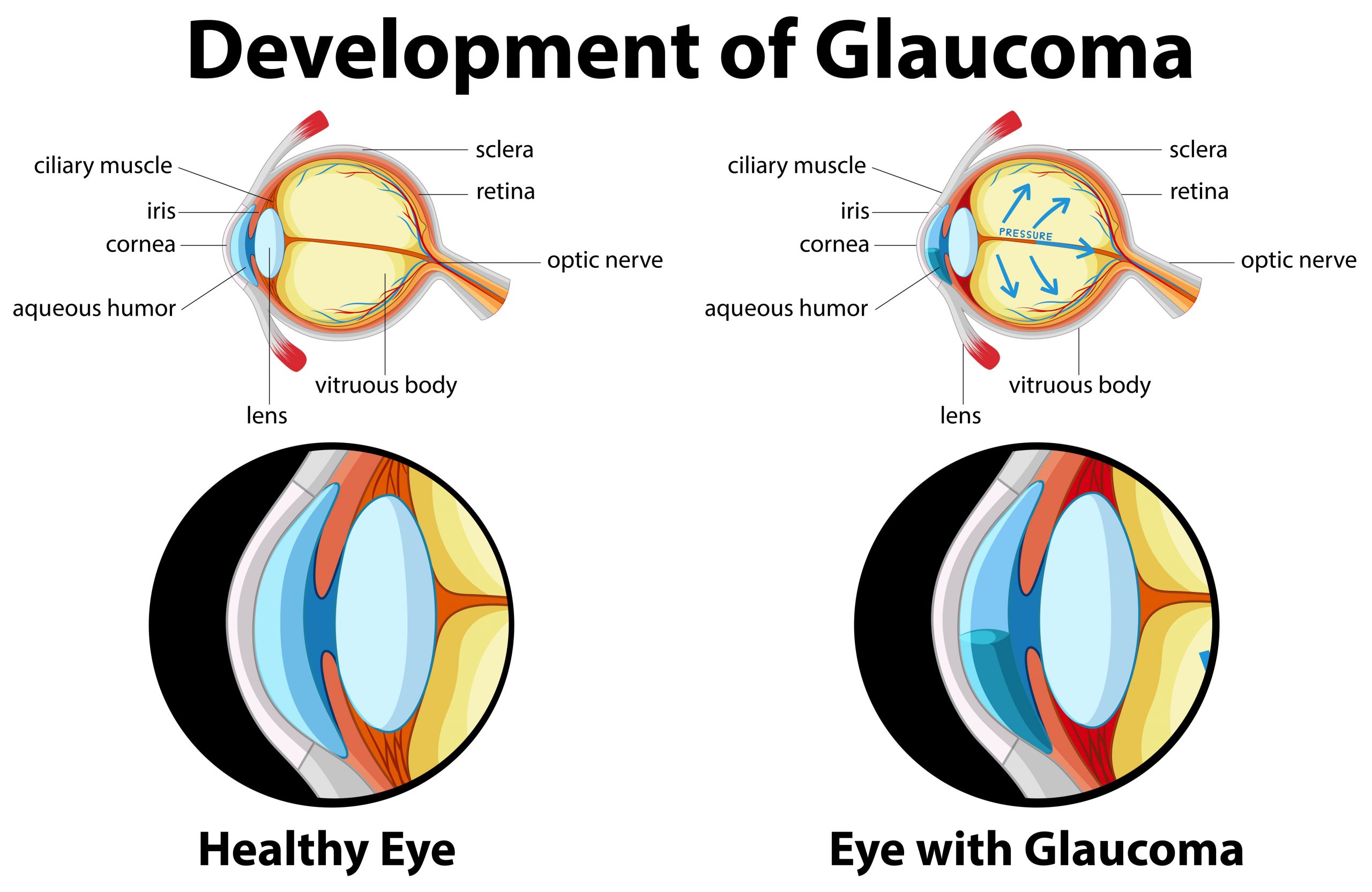 Are You At Risk Of Glaucoma Oasiseye Specialists 