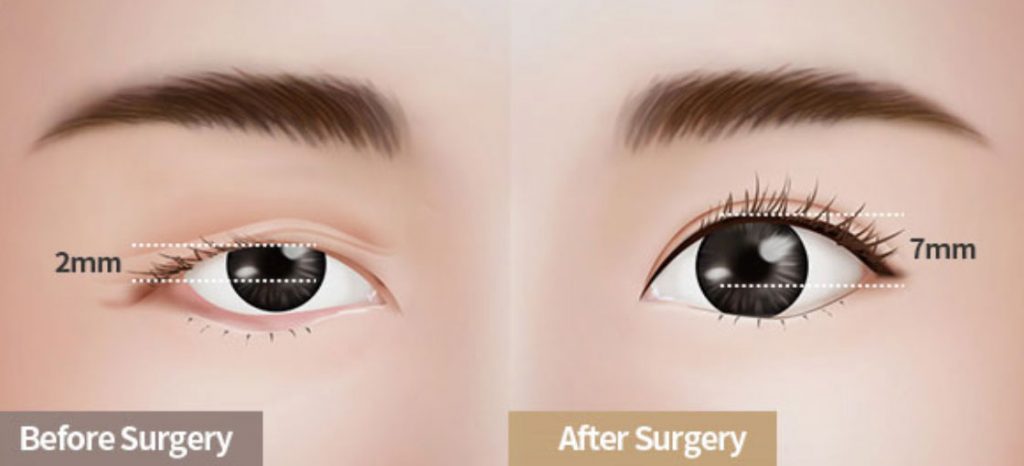 What is a Ptosis? - OasisEye Specialists