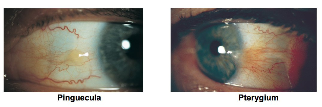 Pinguecula vs. Pterygium: What's the Difference?