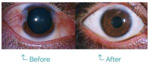 Differences: Pinguecula vs Pterygium - OasisEye Specialists