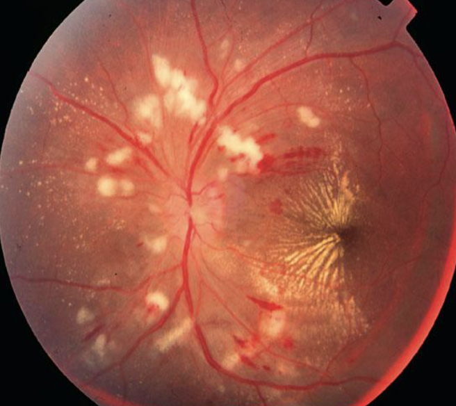 hypertensive retinopathy vs normal