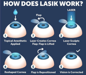 lasik work