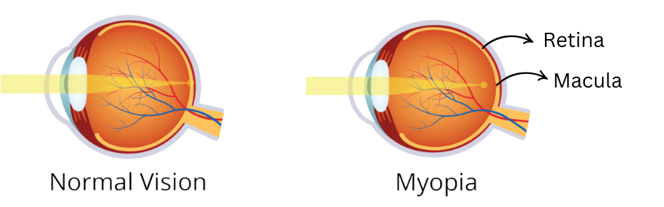 Comparison_of_normal_vision_and_myopia_showing_eye_anatomy._The_normal_eye_focuses_light_directly_on_the_retina,_while_the_myopic_eye_focuses_light_in_front_of_the_retina,_causing_blurred_distance_vision.