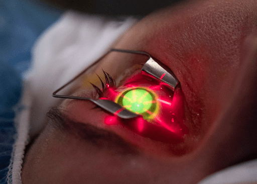 UV_light_applied_during_corneal_cross-linking