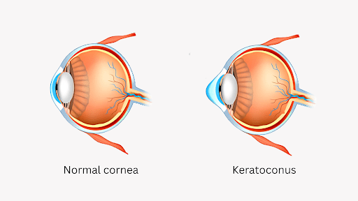 Normal_vs_keratoconus_cornea_diagram 