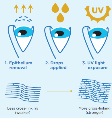 Corneal_cross-linking_steps_illustration 
