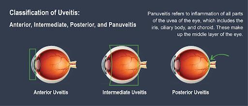 Diagram_showing_anterior,_intermediate_and_posterior_uveitis 
