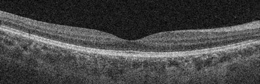 OCT_scan_showing_cross-section_of_the_retina 