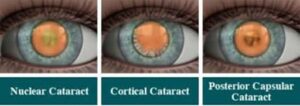 Comparison of three main types of cataracts: nuclear cataract affecting the lens centre, cortical cataract forming spoke-like edges, and posterior subcapsular cataract at the back of the lens