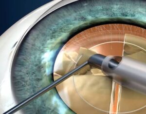 Close-up illustration of cataract surgery showing an instrument breaking and suctioning the cloudy lens during phacoemulsification.
