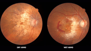 Retinal photographs comparing dry age related macular degeneration and wet age related macular degeneration with visible changes in the macula.