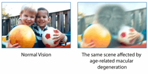 Side by side comparison of normal vision and vision affected by age related macular degeneration showing a blurred central area.