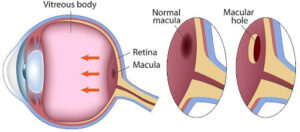 Cross-section diagram of the eye showing the vitreous body pulling on the retina and a comparison between a normal macula and a macular hole.