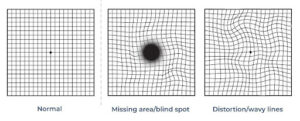 Amsler grid examples comparing normal central vision, a missing central area representing a blind spot, and wavy line distortion caused by a macular hole.