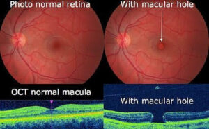 Side-by-side images of a normal retina and a retina with a macular hole, including OCT scans showing the structural difference in the macula.