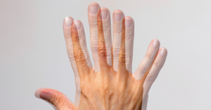 Double Vision (Diplopia)