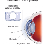 ICL Surgery How an Implantable Contact Lens Can Improve Vision