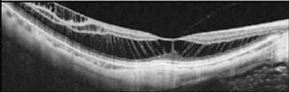 Stage 2 - Foveoschisis