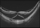 Stage 3 – Foveal Detachment
