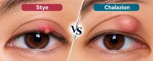Stye vs Chalazion